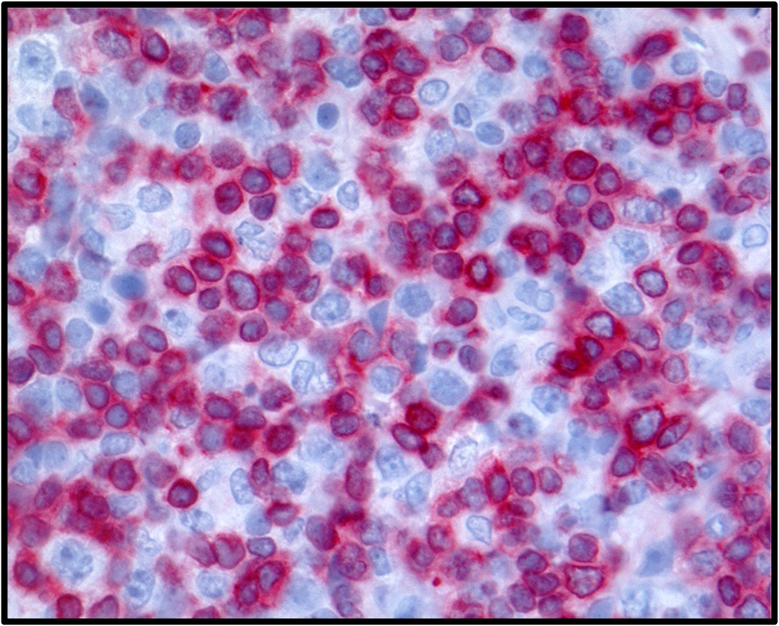 Bessere Therapie gegen schwer behandelbaren Lymphdr&uuml;senkrebs - Titelbild